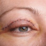 Eyelid Lift Surgeon