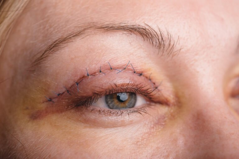 Eyelid Lift Surgeon