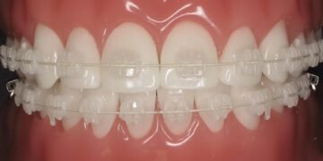 Ceramic Braces