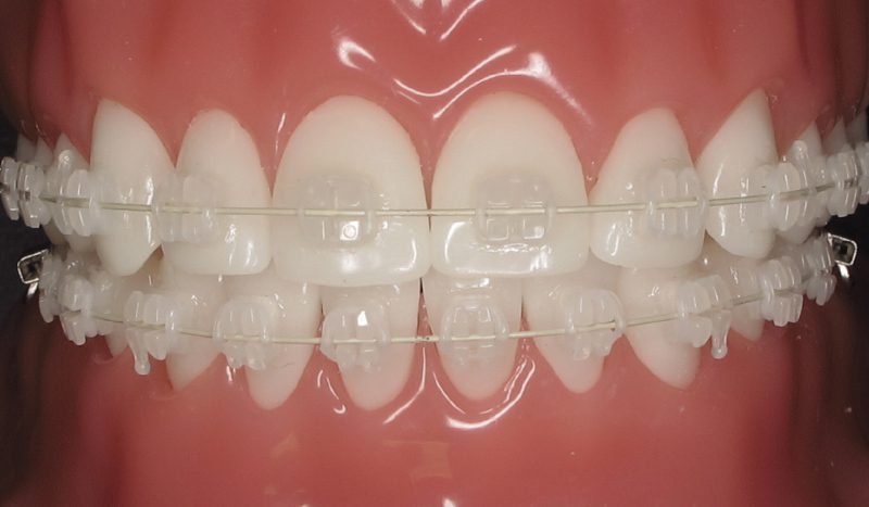 Ceramic Braces