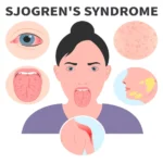 Sjogren's Syndrome