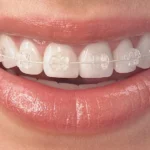 Cosmetic Orthodontic