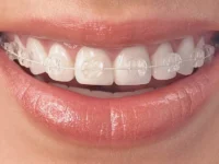 Cosmetic Orthodontic