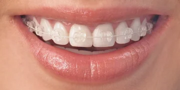 Cosmetic Orthodontic