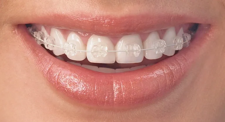 Cosmetic Orthodontic