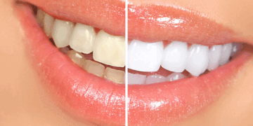 Teeth Whitening