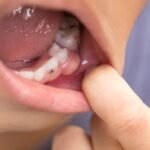 Childhood Cavities