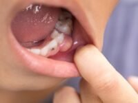Childhood Cavities