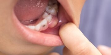 Childhood Cavities