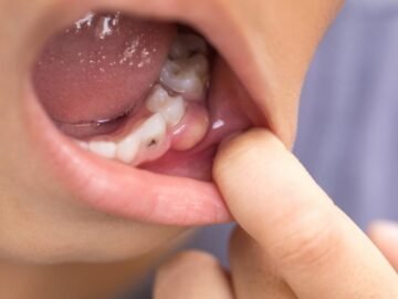 Childhood Cavities