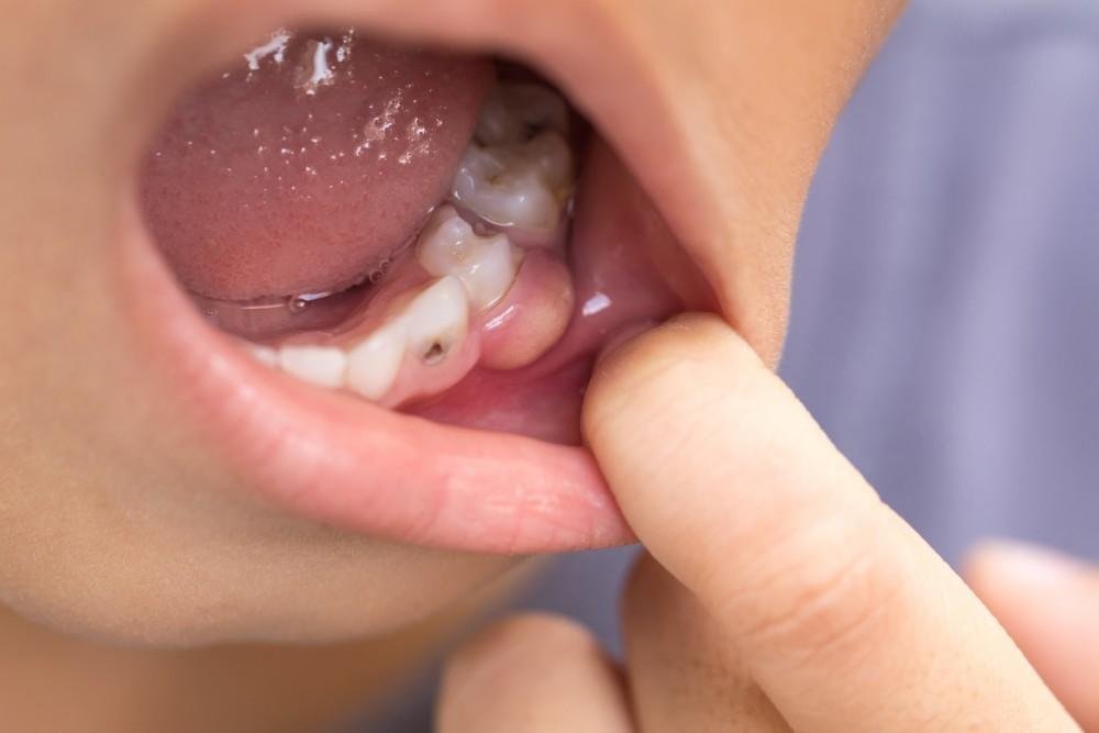 Childhood Cavities