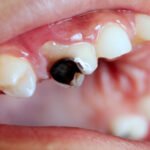 Tooth Decay