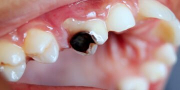 Tooth Decay