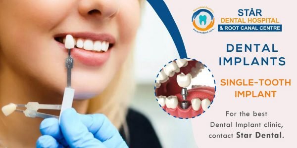 Dental Implants