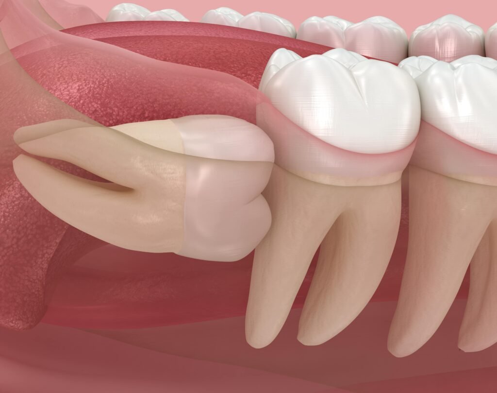 Wisdom Tooth Pain