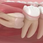 Wisdom Tooth Pain