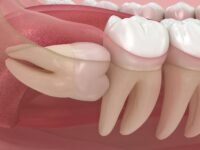 Wisdom Tooth Pain