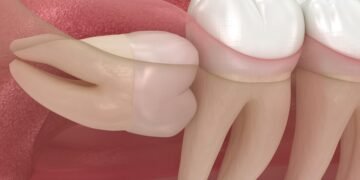 Wisdom Tooth Pain