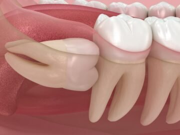 Wisdom Tooth Pain