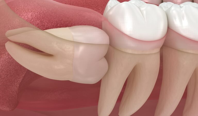 The Surprising Reason Wisdom Tooth Pain Can Affect Your Entire Jaw