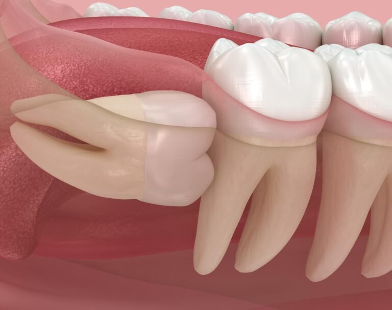 Wisdom Tooth Pain