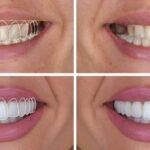 Veneers Design