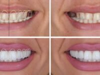 Veneers Design