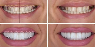Veneers Design