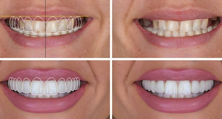 Veneers Design