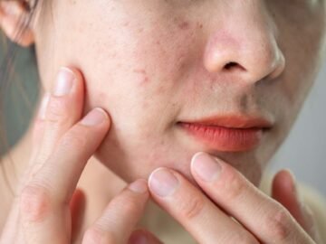Facial Treatments for Uneven Skin Texture