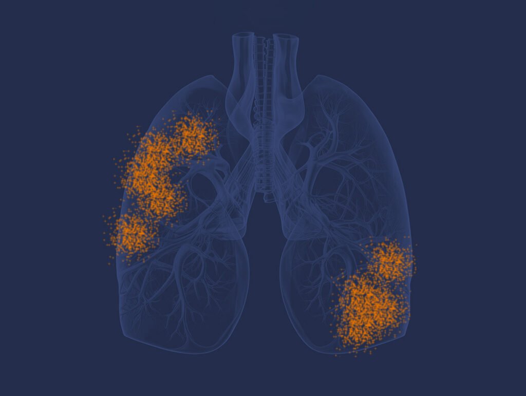 Mesothelioma