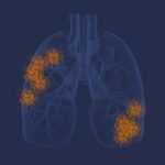 Mesothelioma