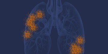 Mesothelioma