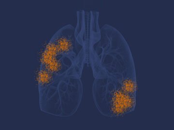 Mesothelioma